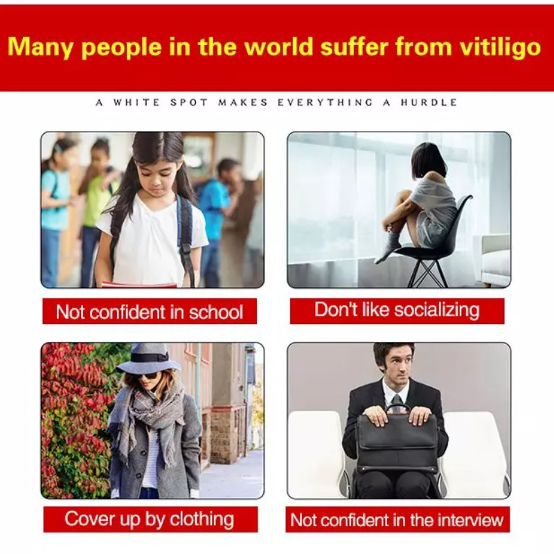 Vitiligo Health Cream Buy 1 Get 1 Free
